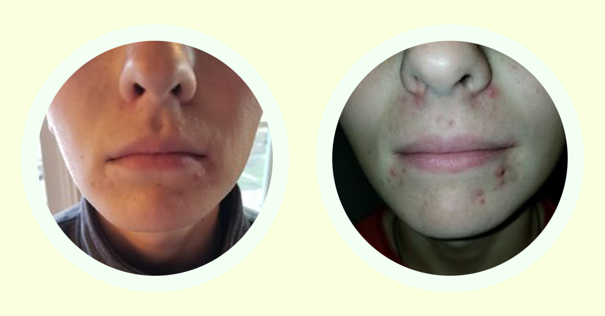 Flash for Facial Acne