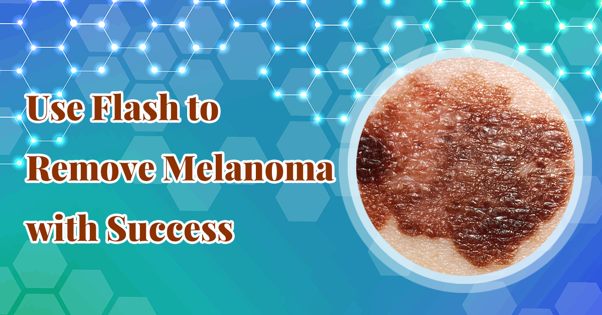 Use Flash to Remove Melanoma with Success