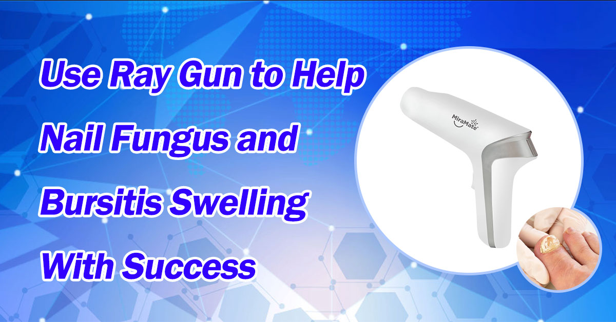 Use Ray Gun to Help Nail Fungus and Bursitis Swelling With Success