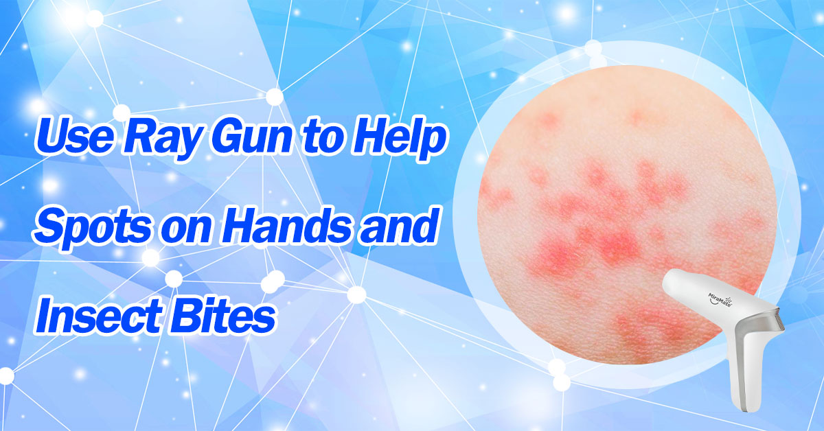 Use Ray Gun to Help Spots on Hands and Insect Bites